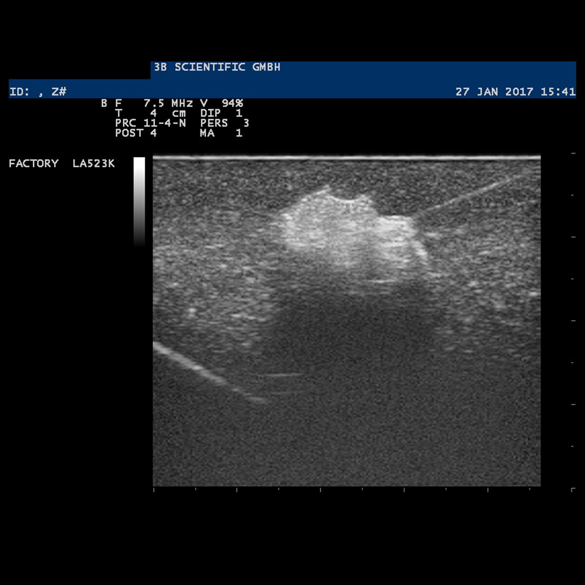 SONOtrain Breast Model with Cysts dark skin