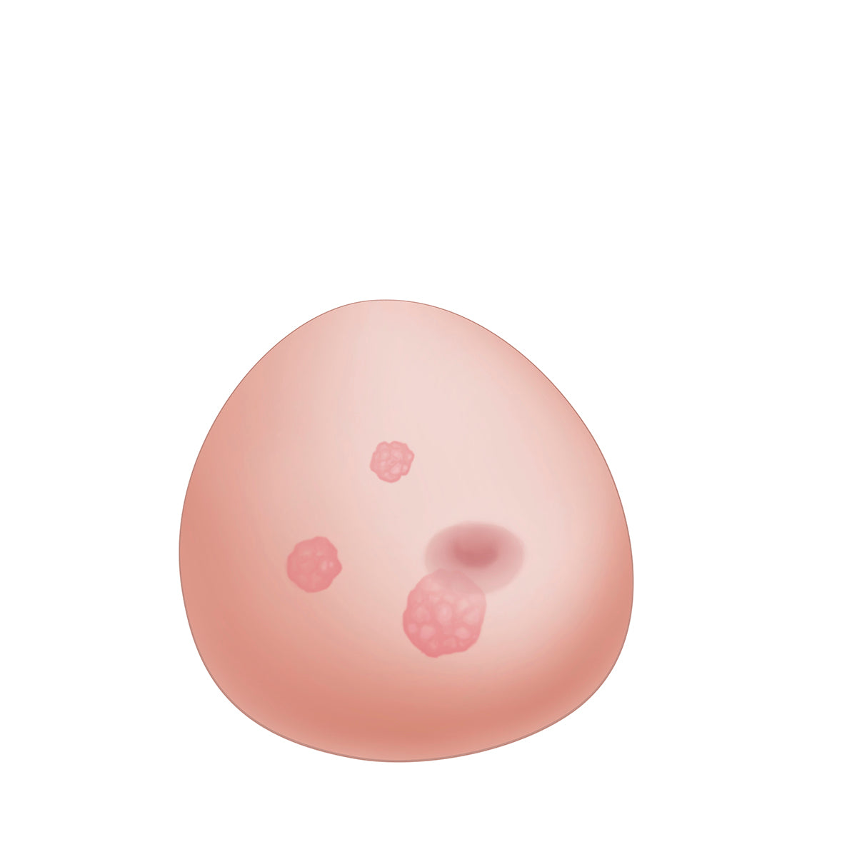 SONOtrain Breast model with tumours - 3B Scientific P125, view 10