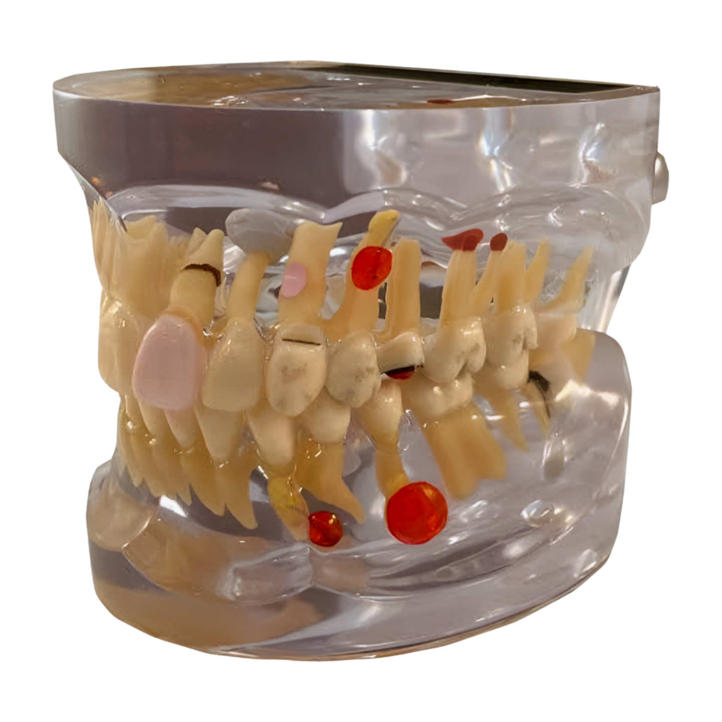 P12P-100M transparent pathology jaw model, normal dentition side