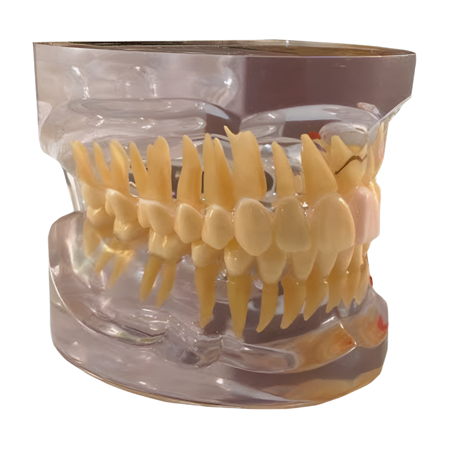 P12P-100M transparent pathology jaw model, pathology side detail