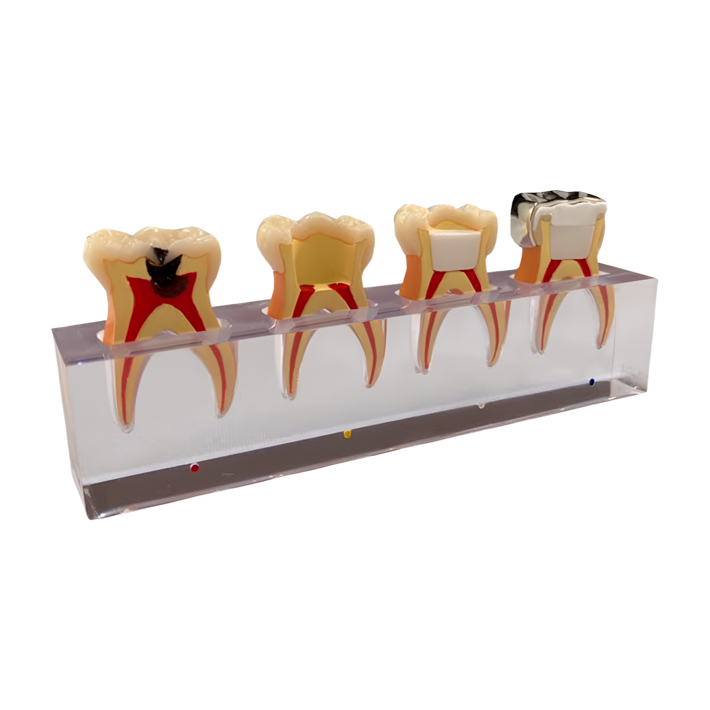P23-X.664 pulpotomy model, 4-tooth sequence overview
