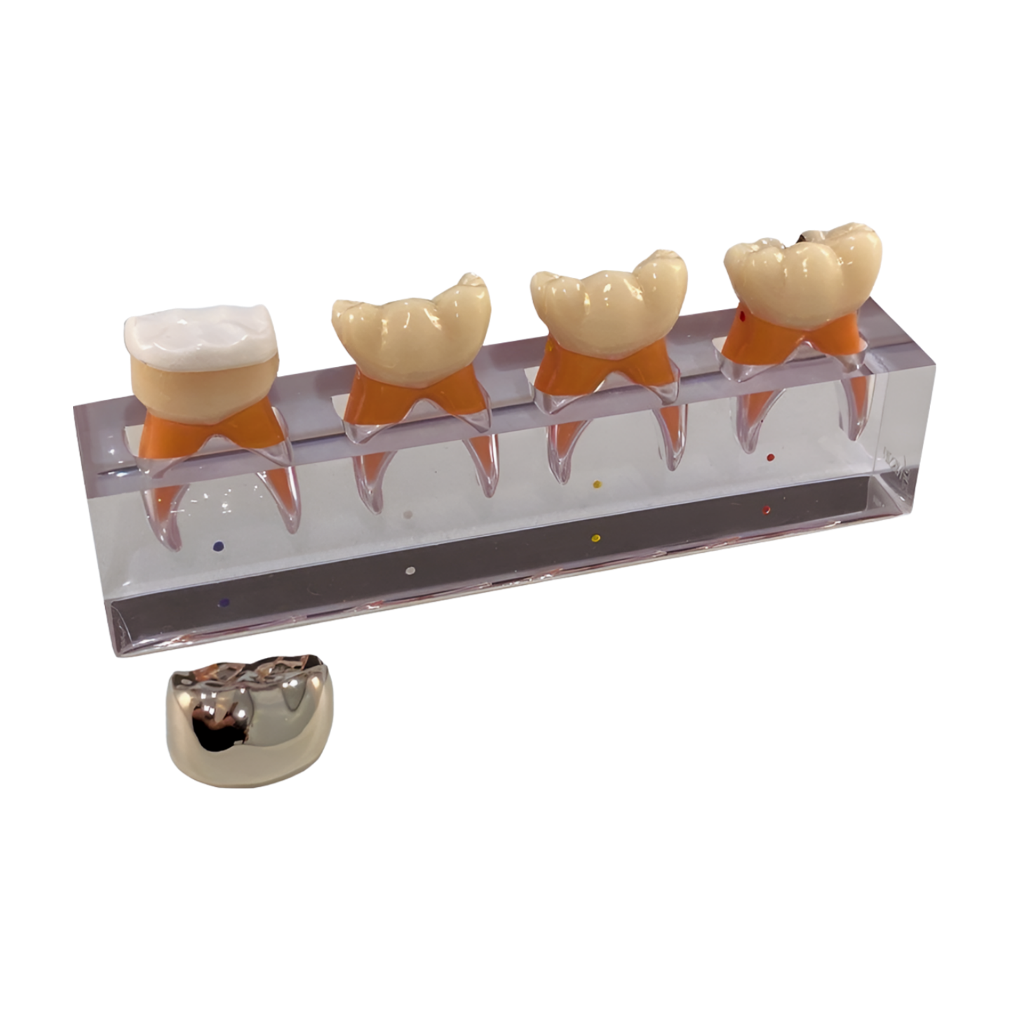 P23-X.664 pulpotomy model, completed procedure with stainless steel crown