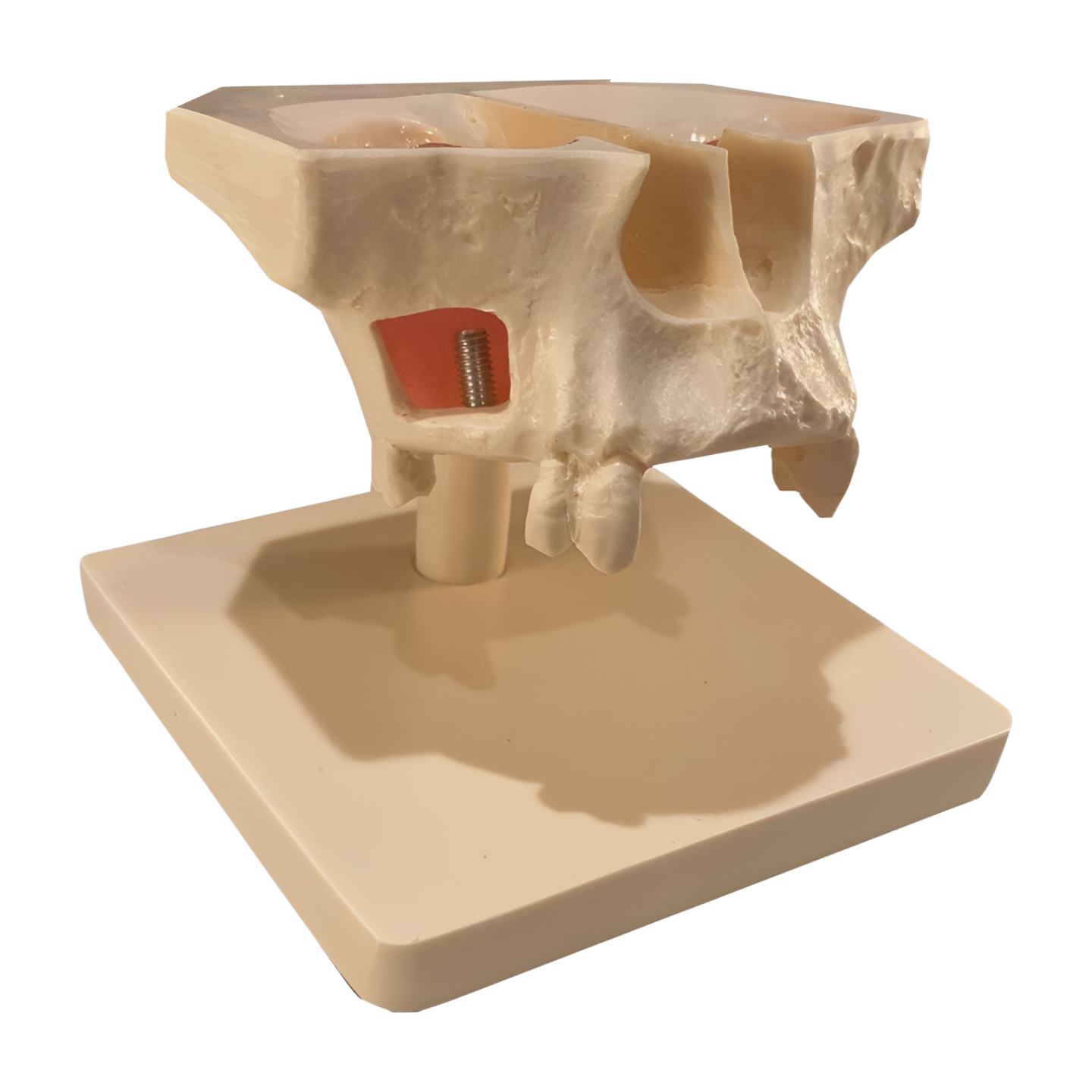 PM-200 – Sinus Lift