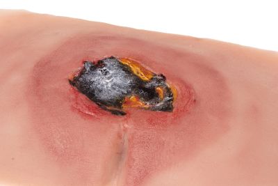 Wound moulage sacral decubitus, untreated