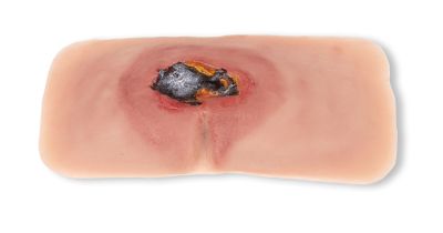 Wound moulage sacral decubitus, untreated