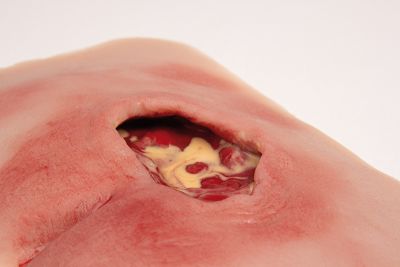 Wound moulage sacral decubitus, cleaned