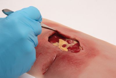 Wound moulage sacral decubitus, cleaned