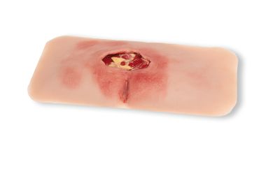 Wound moulage sacral decubitus, cleaned