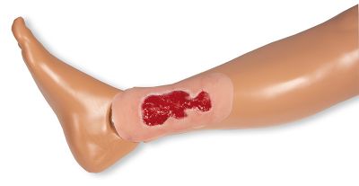 Wound moulage venous leg ulcer, small, granulation phase