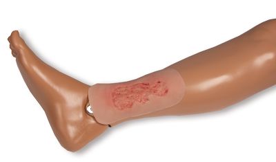 Wound moulage venous leg ulcer, small, epithelization phase