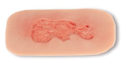 Wound moulage venous leg ulcer, small, epithelization phase
