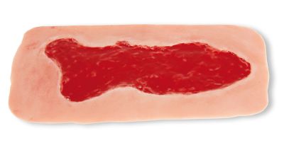 Wound moulage venous leg ulcer, large, granulation phase