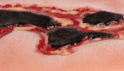 Wound moulage arterial leg ulcer, small, exudation phase
