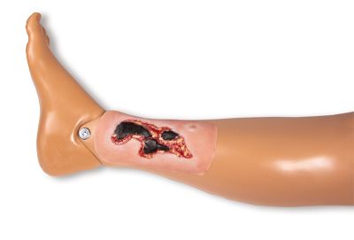 Wound moulage arterial leg ulcer, small, exudation phase