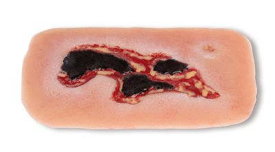 Wound moulage arterial leg ulcer, small, exudation phase