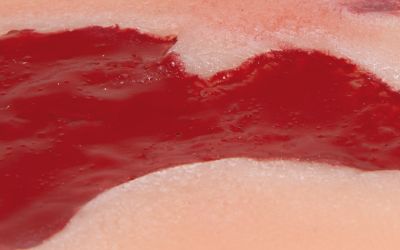 Wound moulage arterial leg ulcer, small, granulation phase