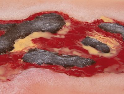 Wound moulage arterial leg ulcer, large, exudation phase