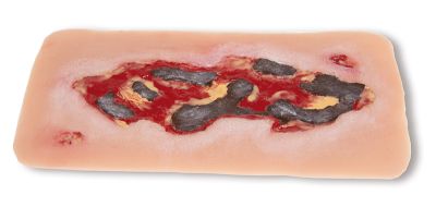 Wound moulage arterial leg ulcer, large, exudation phase