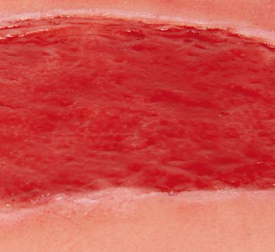Wound moulage arterial leg ulcer, large, granulation phase