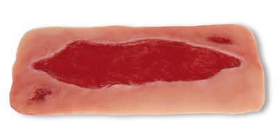Wound moulage arterial leg ulcer, large, granulation phase
