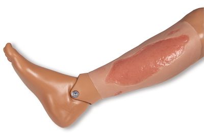 Wound moulage arterial leg ulcer, large, epithelization phase