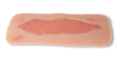 Wound moulage arterial leg ulcer, large, epithelization phase