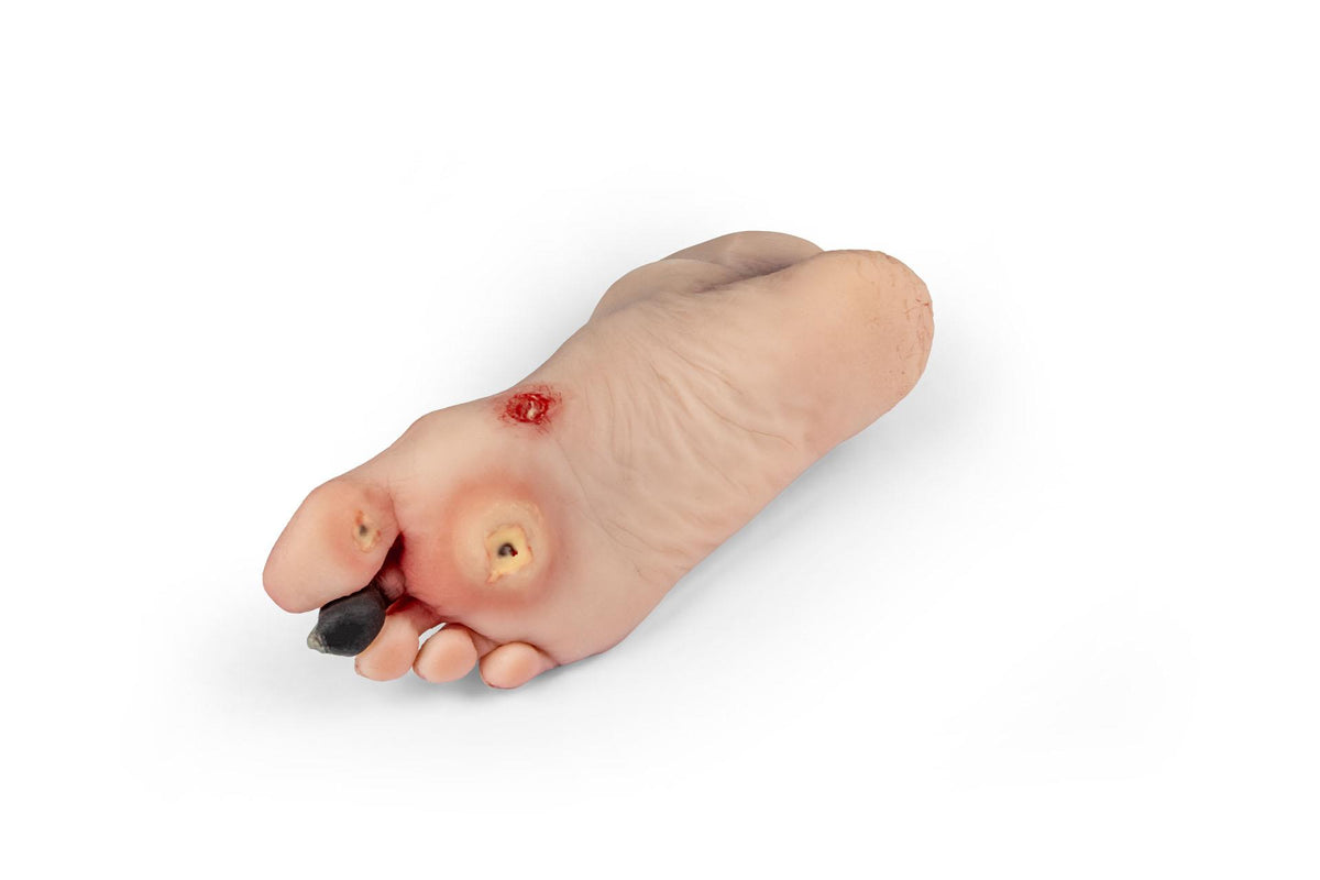 Wound foot with diabetic foot syndrome for Nursing Anne | Erler-Zimmer PW006NA