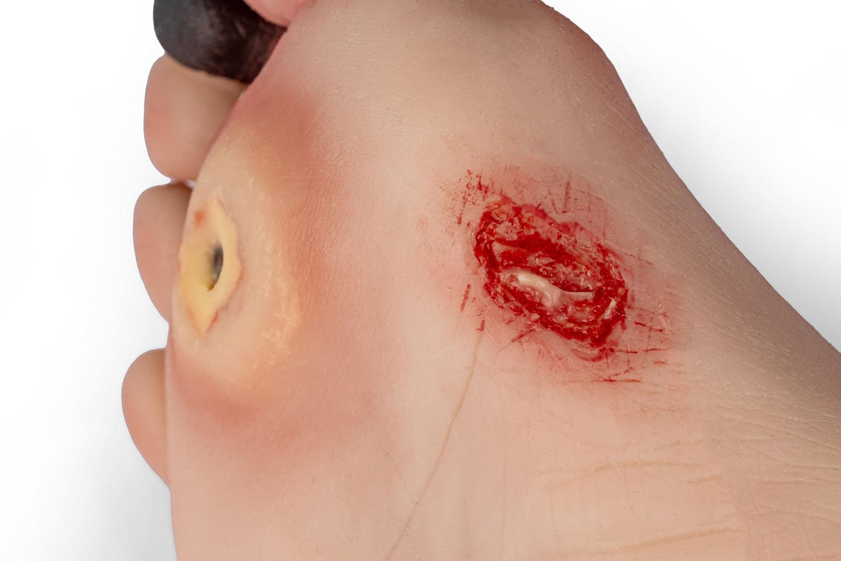 Wound foot with diabetic foot syndrome for Nursing Anne | Erler-Zimmer PW006NA