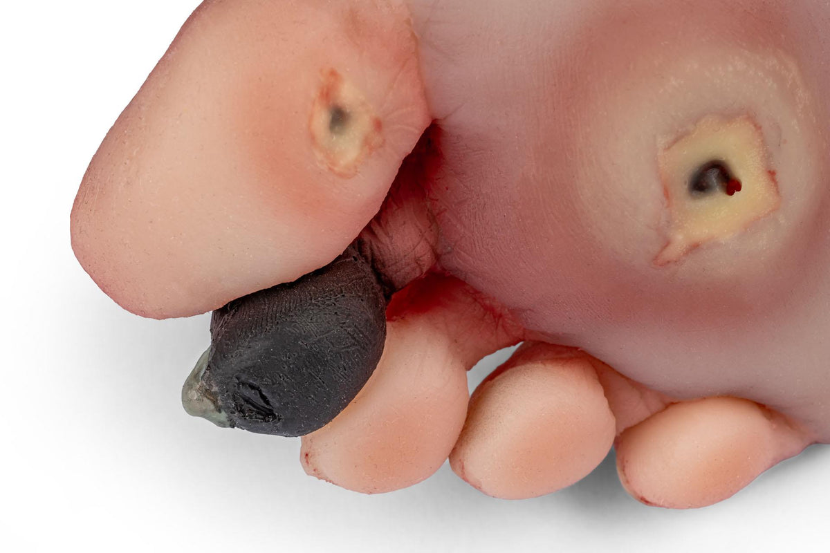 Wound foot with diabetic foot syndrome for Nursing Anne | Erler-Zimmer PW006NA