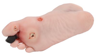 Wound foot with diabetic foot syndrome - Erler-Zimmer PW006, view 4