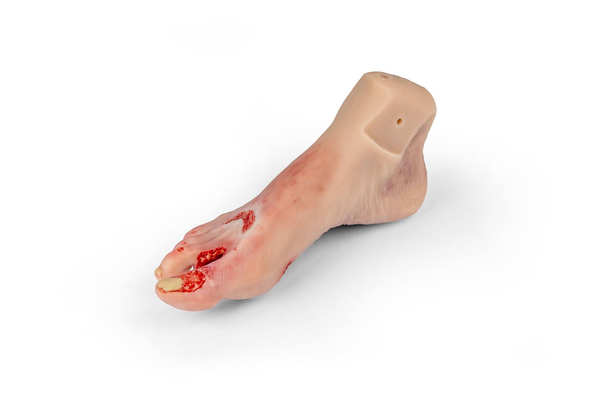 Wound foot with diabetic foot syndrome, severe stage, Nurisng Anne version | Erler-Zimmer PW007NA