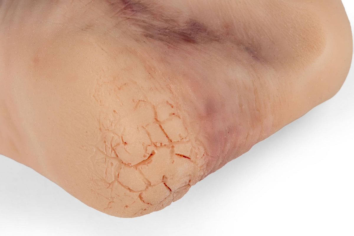 Wound foot with diabetic foot syndrome, severe stage, Nurisng Anne version | Erler-Zimmer PW007NA