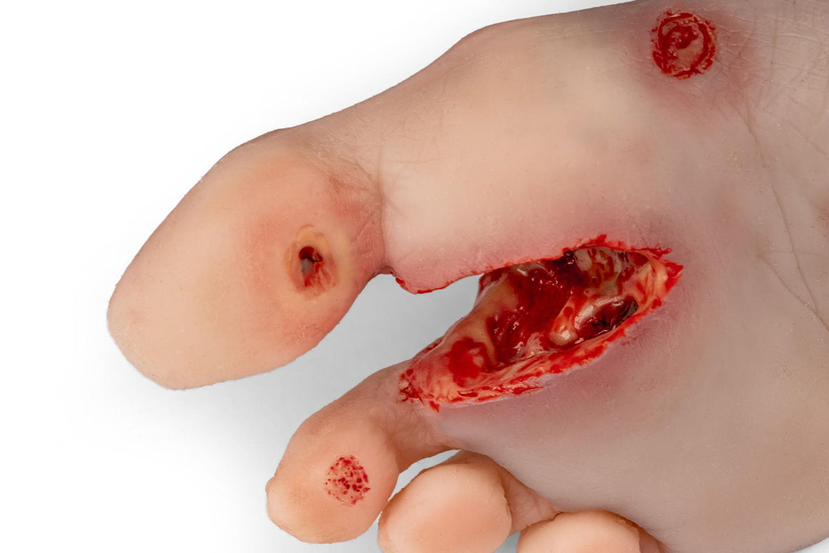 Wound foot with diabetic foot syndrome, severe stage, Nurisng Anne version | Erler-Zimmer PW007NA