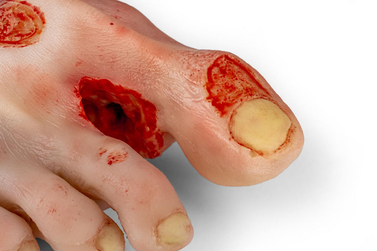 Wound foot with diabetic foot syndrome, severe stage, Nurisng Anne version | Erler-Zimmer PW007NA