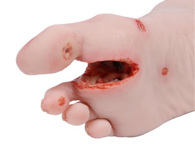 Wound foot with diabetic foot syndrome, severe stage - Erler-Zimmer PW007, view 6