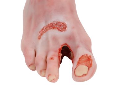 Wound foot with diabetic foot syndrome, severe stage - Erler-Zimmer PW007, view 7