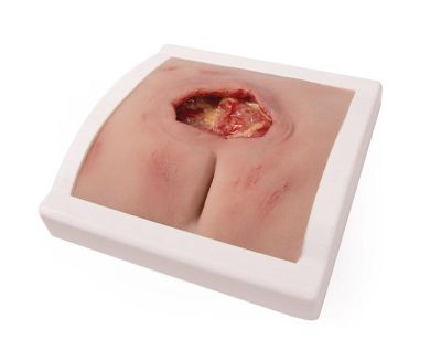 Wound moulage sacral decubitus, cleaned including stand - Erler-Zimmer PW008BTM