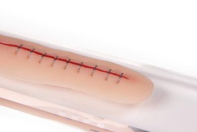 Surgical wound with staples, 22cm - Erler-Zimmer PW009C
