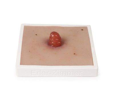 Wound Moulage Ileostomy, incl. stand - Erler-Zimmer PW020