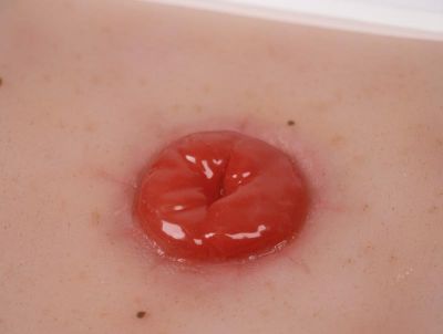 Wound Moulage Colostomy, incl. stand - Erler-Zimmer PW021, view 3