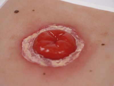 Wound Moulage Colostomy with inflammation, incl. stand - Erler-Zimmer PW022, view 4