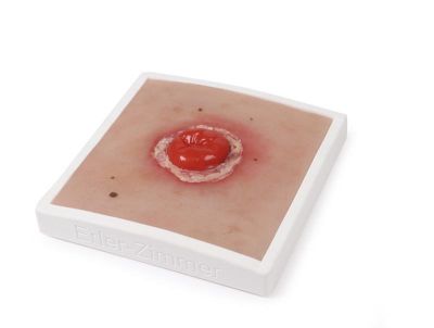 Wound Moulage Colostomy with inflammation, incl. stand - Erler-Zimmer PW022