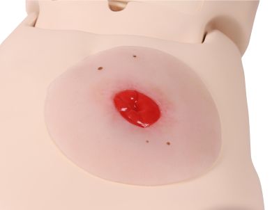 Wound moulage Colostomy below skin level, self-adhesive - Erler-Zimmer PW024P, view 3
