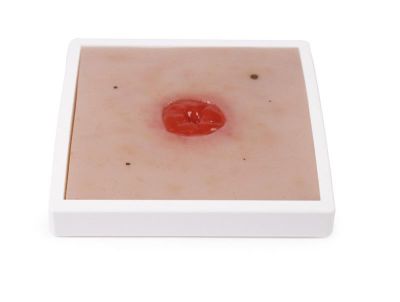 Wound Moulage Colostomy under skin level, incl. stand - Erler-Zimmer PW024, view 2