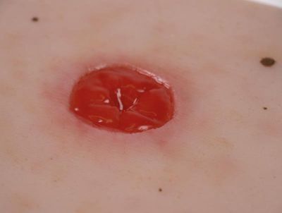 Wound Moulage Colostomy under skin level, incl. stand - Erler-Zimmer PW024, view 3