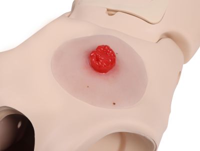 Wound moulage colostomy double-barrel, self-adhesive - Erler-Zimmer PW025P, view 3