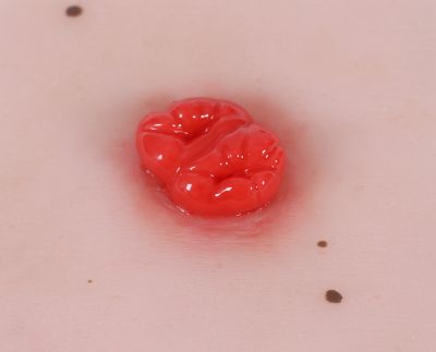 Wound moulage colostomy double-running, incl. stand - Erler-Zimmer PW025, view 3