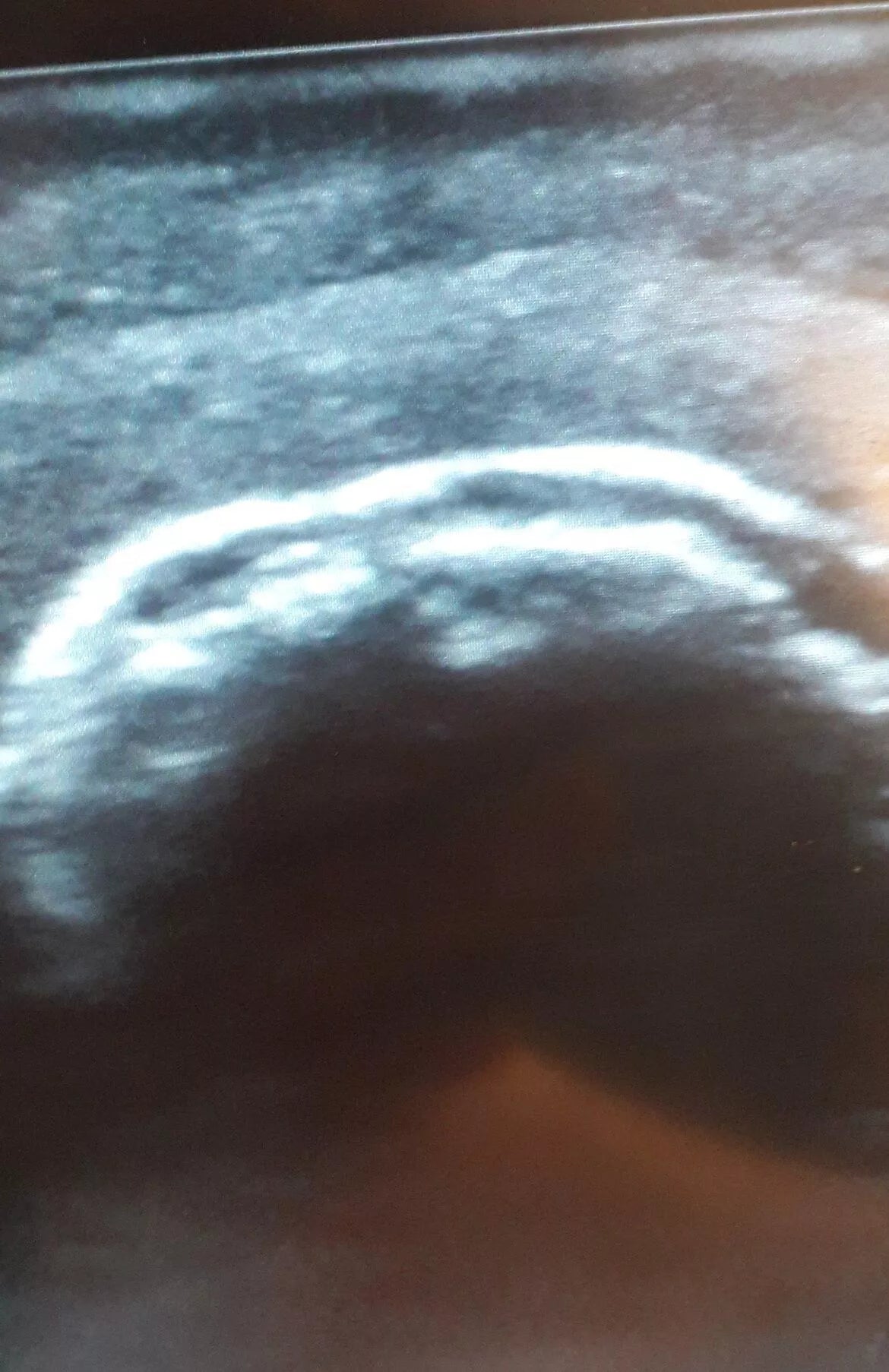 Ultrasound - Shoulder exercise model - Erler-Zimmer SEZ-SH, view 8