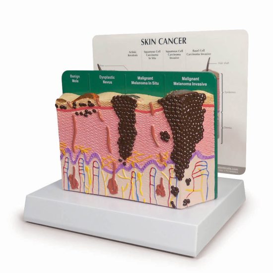 Skin Cancer Model 3855 — GPI Anatomicals | Candent Canada