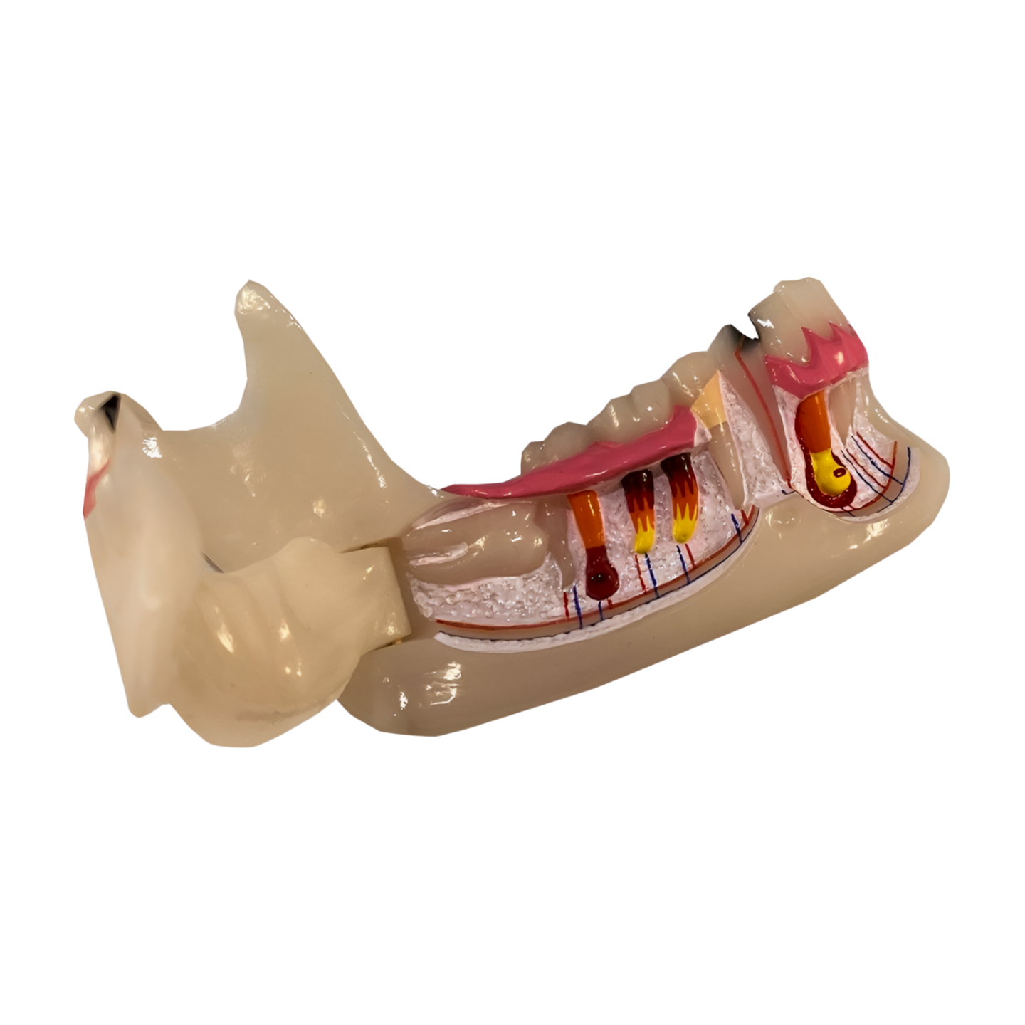 P13-TR.10 pathological mandible, hinged buccal plate open